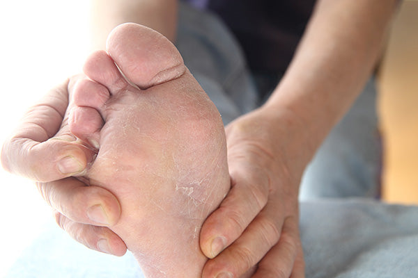 Athlete’s Foot