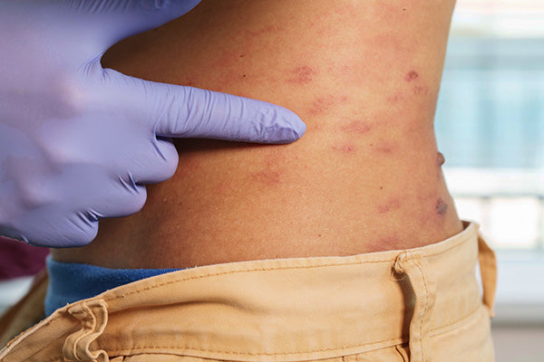Herpes