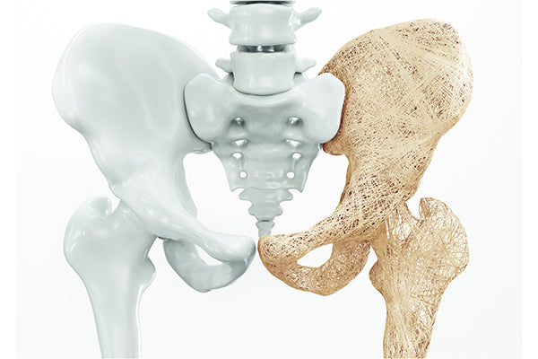 Osteoporosis