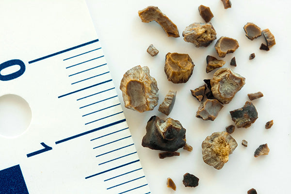 Ureteral Stone